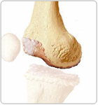 Damaged Portions of the Femur and Cartilage Before Cutting